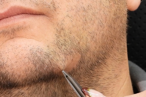 peli incarniti nella barba rimuovere